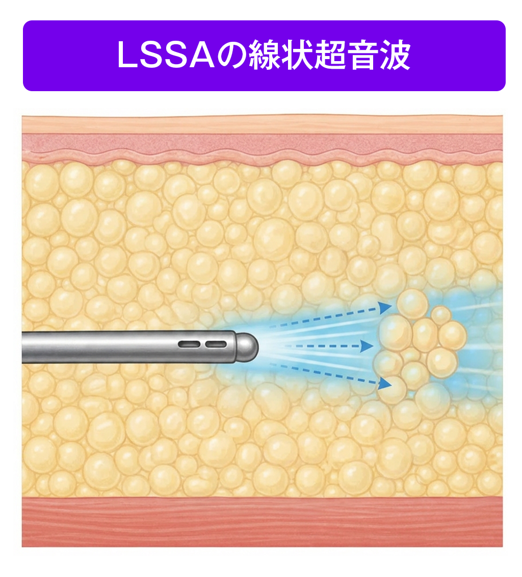 LSSA 線状超音波