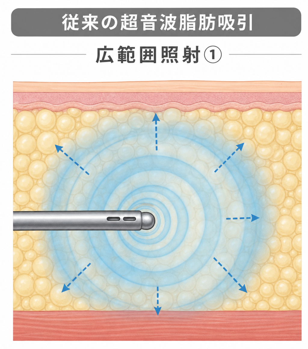 従来超音波脂肪吸引 広範囲照射