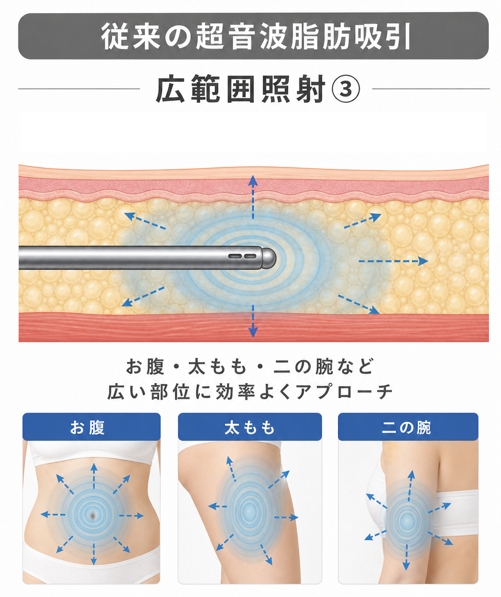 従来超音波脂肪吸引 ボディ向き