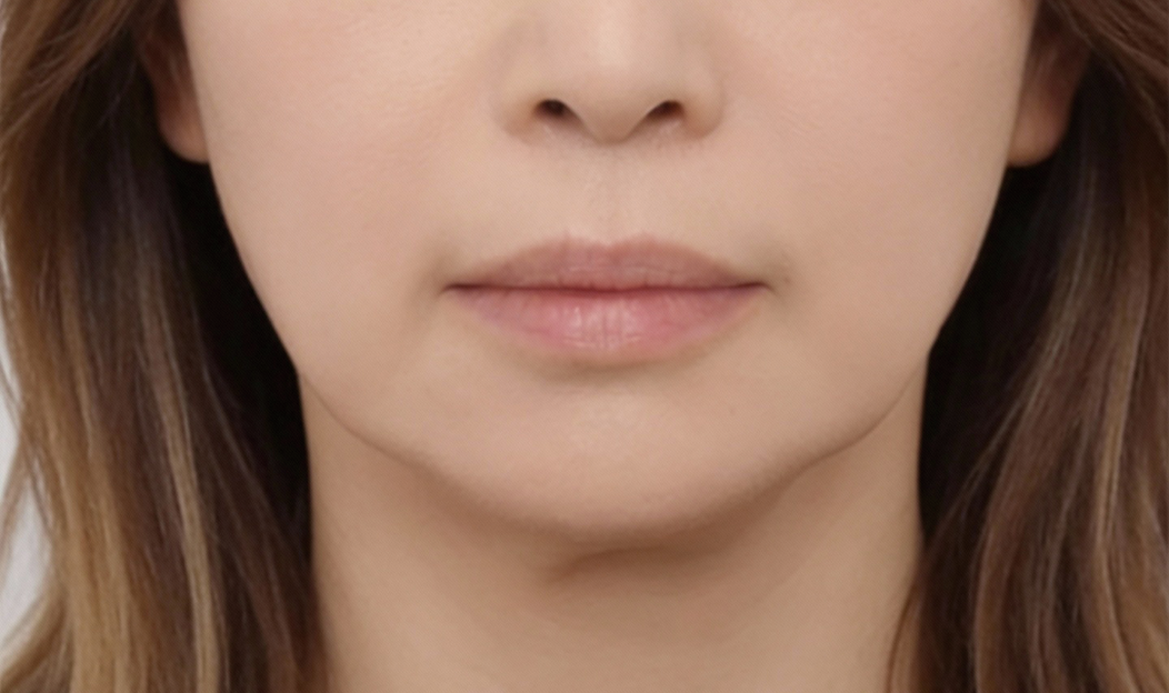 50代女性 フェイスライン たるみ XERF施術後 大阪梅田 美容皮膚科