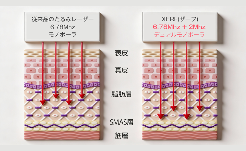 XERF 深層加熱イメージ 大阪梅田 美容皮膚科